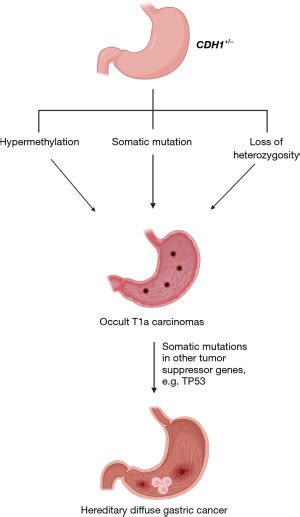 Cdh And Hereditary Diffuse Gastric Cancer A Narrative Review