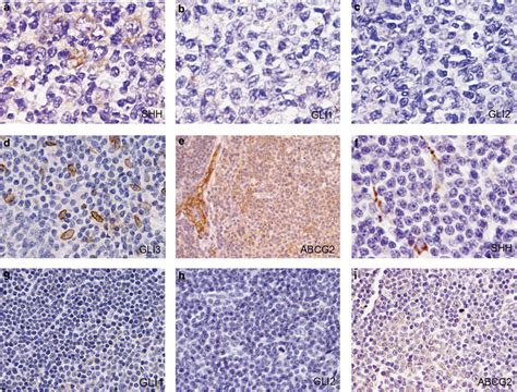 Sonic Hedgehog Signaling Proteins And Abcg Expression In Follicular