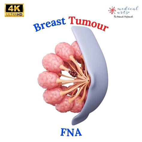 Understanding Breast Lumps And Fineneedle Aspiration Fna 🎥 Video Inclu