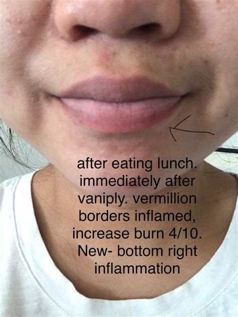 HELP LIP ECZEMA ALLERGY? desperate. Please read notes : r/eczema