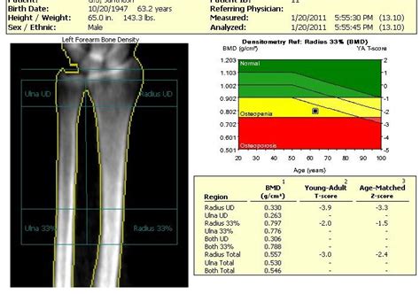 DXA Scan - Anandorthopedic