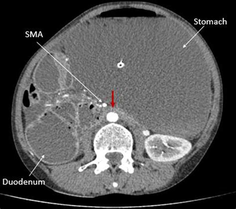 Superior Mesenteric Artery Syndrome Ct Findings Bmj Case Reports