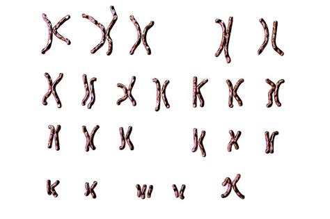 Downs Syndrome Karyotype Photograph By Kateryna Konscience Photo Library Pixels