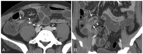 Diagnostic Imaging Of Appendicitis With Supplementation By