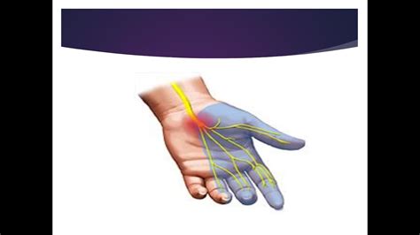 Carpal Tunnel Syndrome Youtube