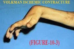 Volkmann Ischemic Contracture Treatment in Chennai | ID: 7621998112