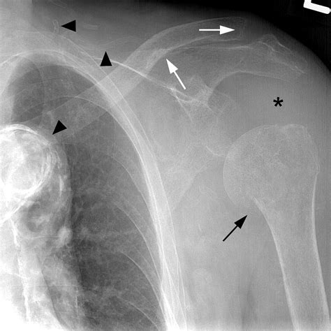 Various Musculoskeletal Manifestations Of Chronic Renal Insufficiency Clinical Radiology