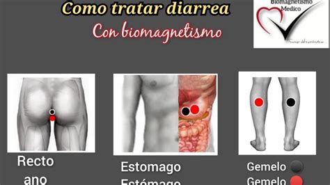 Biomagnetismo Como Tratar La Diarrea Con Biomagnetismo Youtube