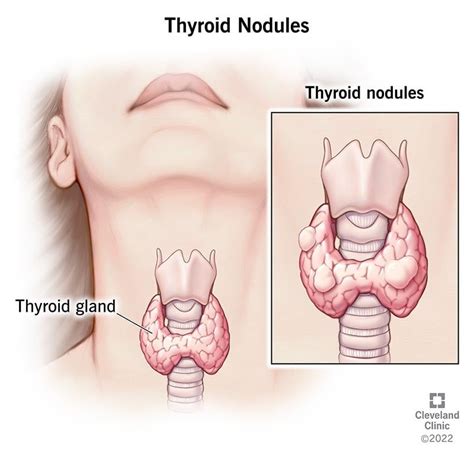 Thyroid Nodules Causes Symptoms Treatment Artofit