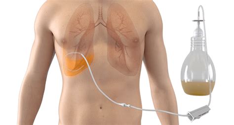 Pleurx Catheter