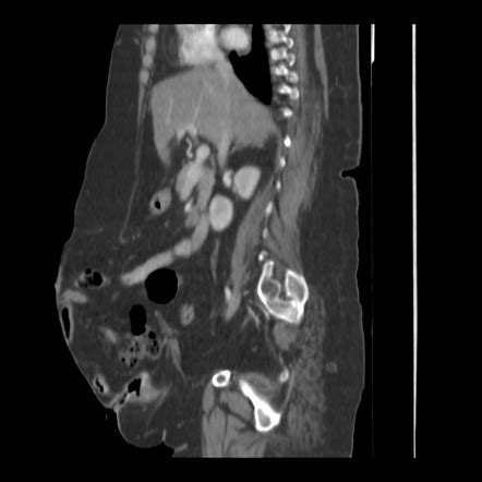 Large Ventral Hernia With Ileal Diverticulitis Within The Hernial Sac