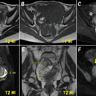 Findings of CE -MRI of the right ovarian tumor performed about 1 year ...