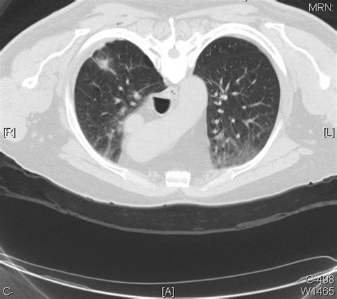 Basaloid Squamous Cell Carcinoma Ct Scan Case 275 Peripher… Flickr