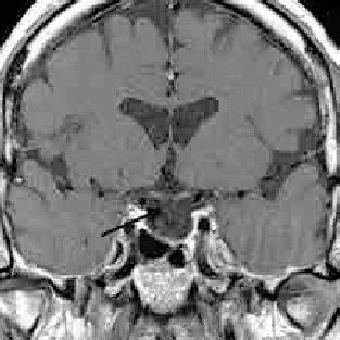 Case 2 postoperative pituitary MRI scan. (a) Contrast-enhanced... | Download Scientific Diagram