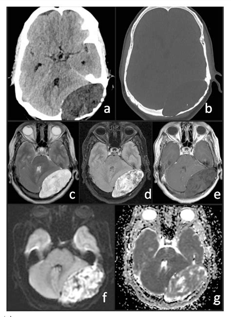 Figure I From Intradiploic Epidermoid Cyst Of The Skull Semantic Scholar