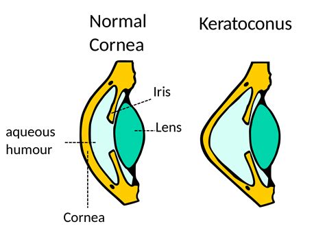 Keratoconus | Coan Eye Care