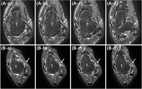 Nonanatomic All Inside Arthroscopic Anterior Talofibular Off