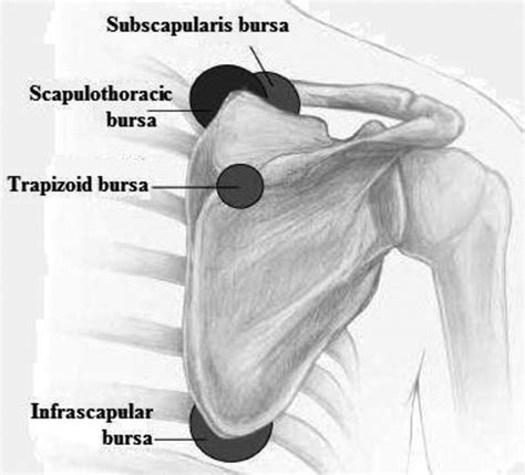 Subscapular Bursitis