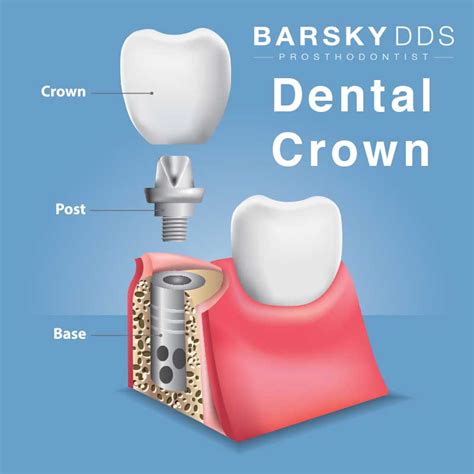 dental-crown-3-part-diagram-1 - Todd B. Barsky, DDS