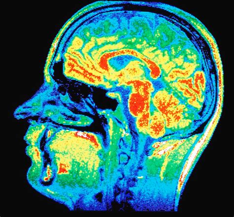 Neurological Genetic Testing - Clear Bridge BiOMEDICS