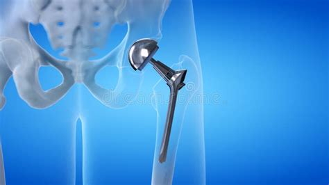 A Hip Replacement Stock Illustration Illustration Of Prosthetics