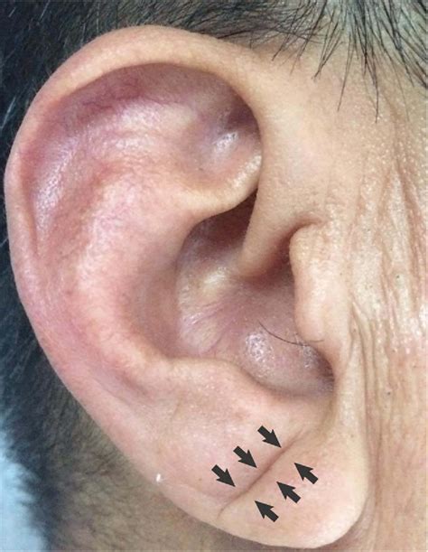 Figure 1 From Patients With Earlobe Crease May Associate With Lower