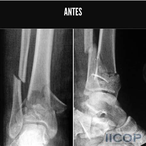 Fractura De Pil N Tibial Los Mejores Especialistas En Cirug A De Pie