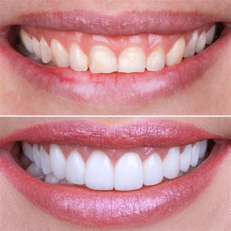 Emax Veneers In Turkey Can Be Completed In Days