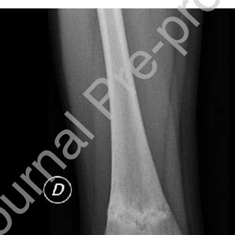 X-rays showing Erlenmeyer flask deformity in both femurs and femoral... | Download Scientific ...