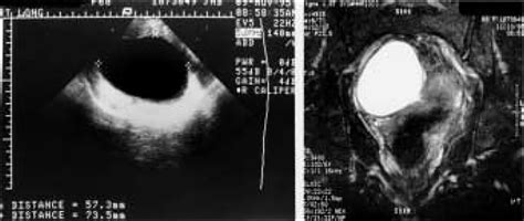 Postmenopausal Virilization Simple Ovarian Cyst And Hilus Cell