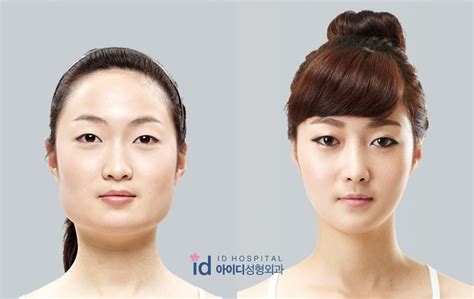 Id Hospital Korea Id Hospital In The News The Secret To An Ideal V