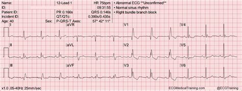 How To Calculate Heart Rate By Ecg 2022