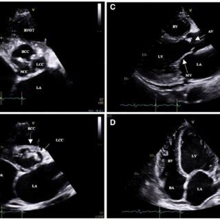 Transthoracic Echocardiogram Images A B Parasternal Short Axis Views