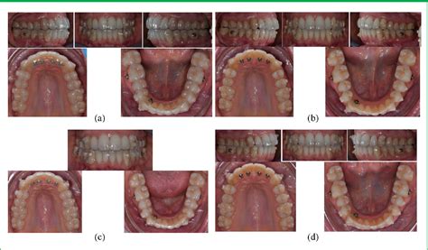 Treatment Of Severe Class Ii Skeletal Malocclusion In A Hyperdivergent Adult Patient Via Hybrid