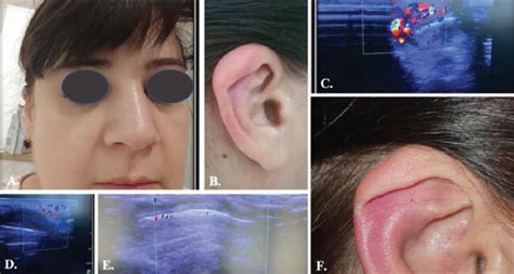 Figure A shows significant inflammation of the nasal bridge, figures B... | Download Scientific ...