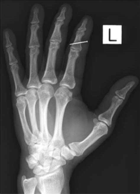 Mastering Minor Care Hand Lacerations Laptrinhx News