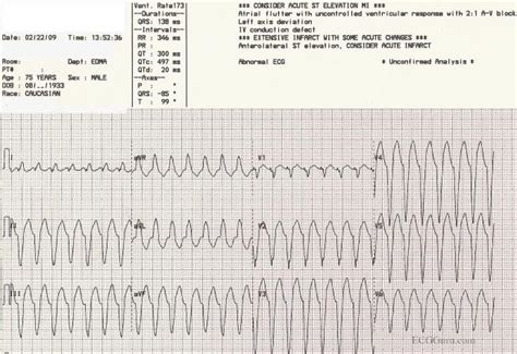 V Tach Ecg Guru Instructor Resources