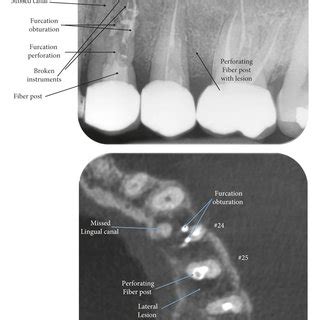 The Initial Periapical Radiography And The Axial Section Of Cbct Scans