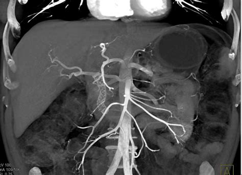 Invasive Adenocarcinoma Head Of The Pancreas With Local Spread And