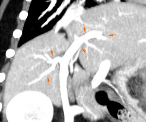 Extrahepatic portosystemic shunt in a dog - ProtonVet