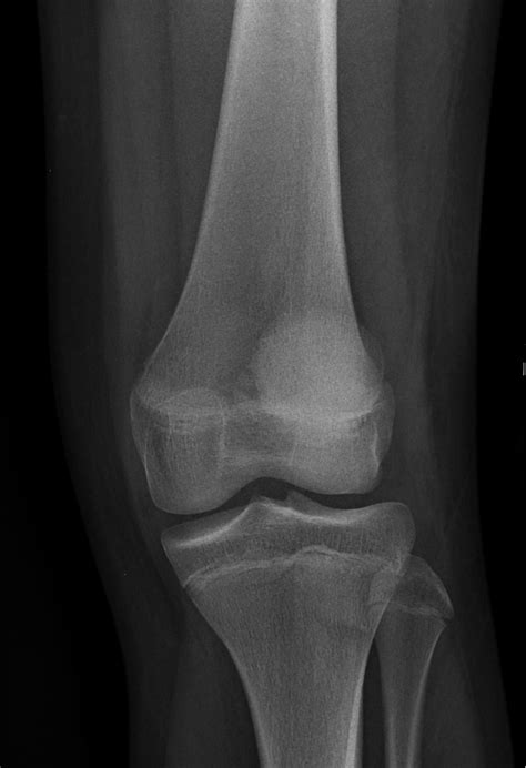 Medial Patellar Retinaculum Tear