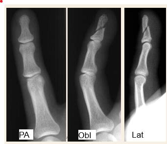 Upper Extremity Skeletal Imaging Part Flashcards Quizlet