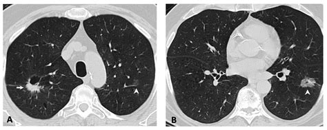 Cancers Free Full Text Clinicopathologic And Imaging Features Of Non Small Cell Lung Cancer