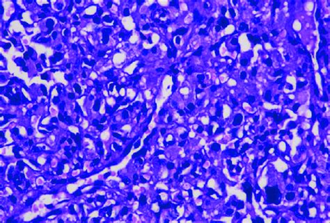 Photomicrograph Depicting Lobules And Nests Of Epithelioid Cells