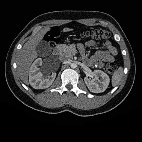 Pelvi Ureteric Junction Puj Obstruction From Accessory Renal Artery Image