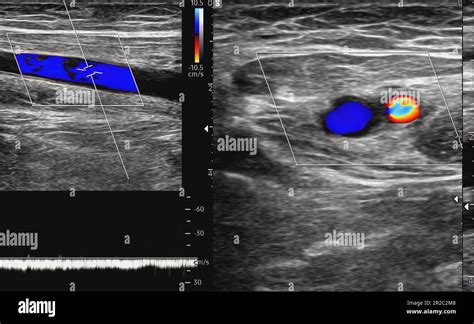 A Carotid Artery Doppler Ultrasound Is A Diagnostic Test Used To Check