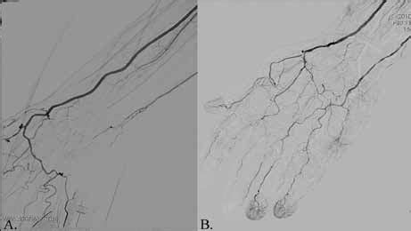 Selective angiography shows an ulnar artery occlusion | Download ...