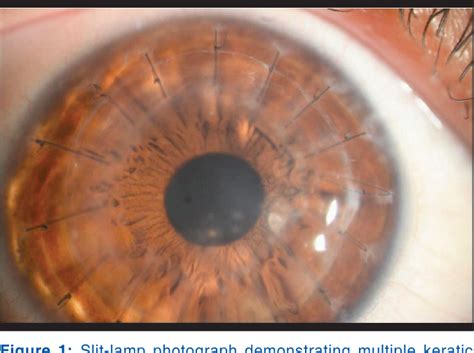 Figure 1 From Candida Albicans Interface Infection After Deep Anterior Lamellar Keratoplasty