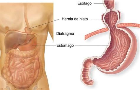 CIRUGÍA DE HERNIA HIATAL Cirugía Sin Fronteras CSF