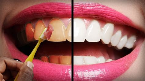 In Just 2 Minutes Turn Yellow Teeth To White Naturally Teeth Whitening With This Method Youtube